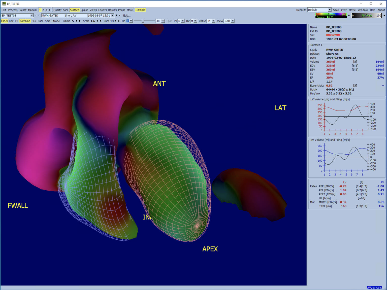QBS Quantitative Blood Pool SPECT QUAD CedarsSinai