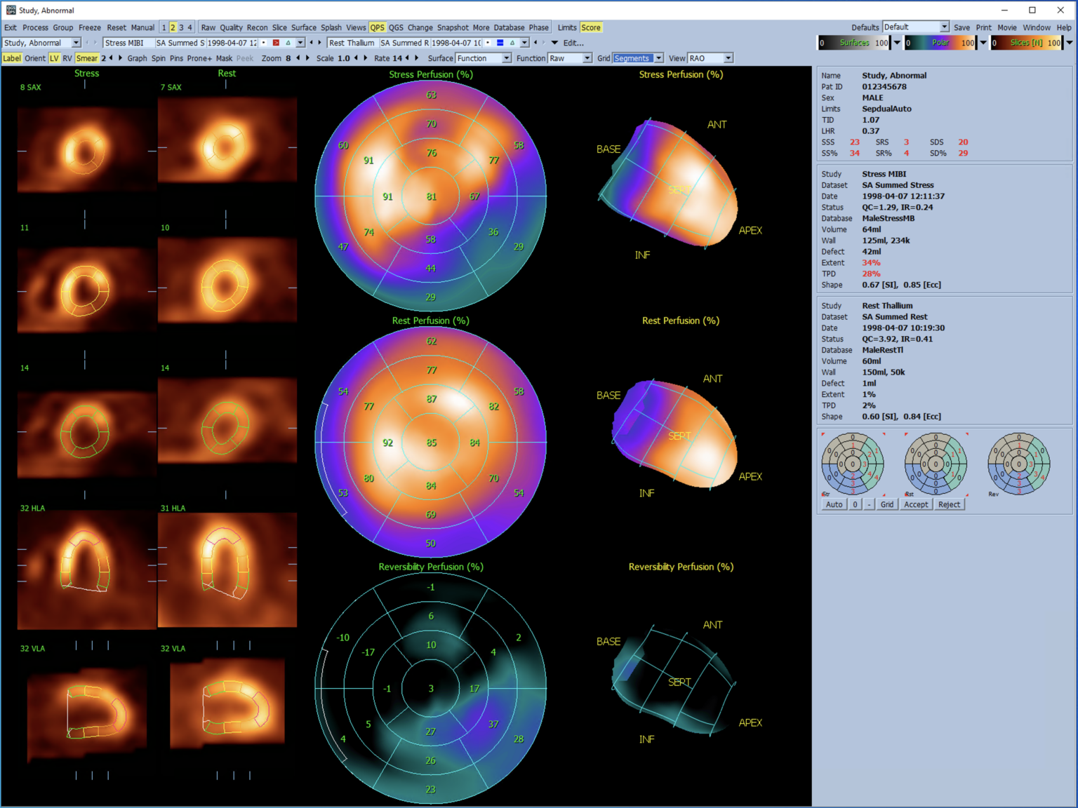 QGS+QPS Quantitative Gated+Perfusion SPECT QUAD CedarsSinai