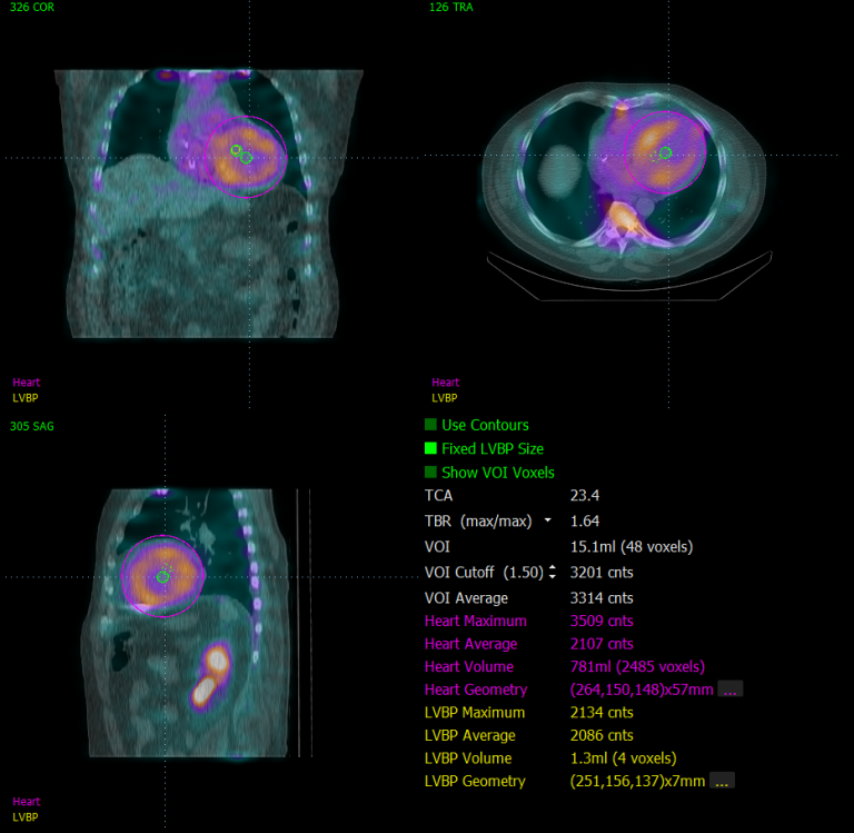 Cardiac Suite for Amyloidosis - QUAD Cedars-Sinai