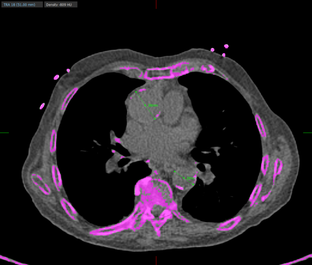 Example use of annotations to measure ascending and descending aortic diameters