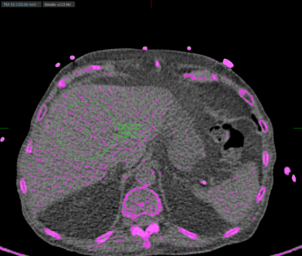 Example use of annotations to measure liver attenuation