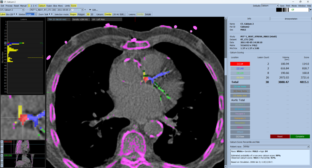 Patient with multivessel lesions in the Calcium page