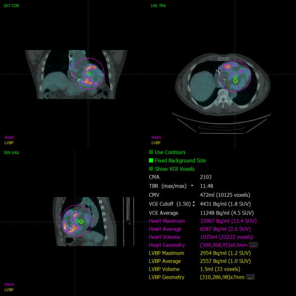 Cardiac Suite for Sarcoidosis - QUAD Cedars-Sinai